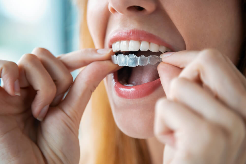 Gouttière orthodontique G&L