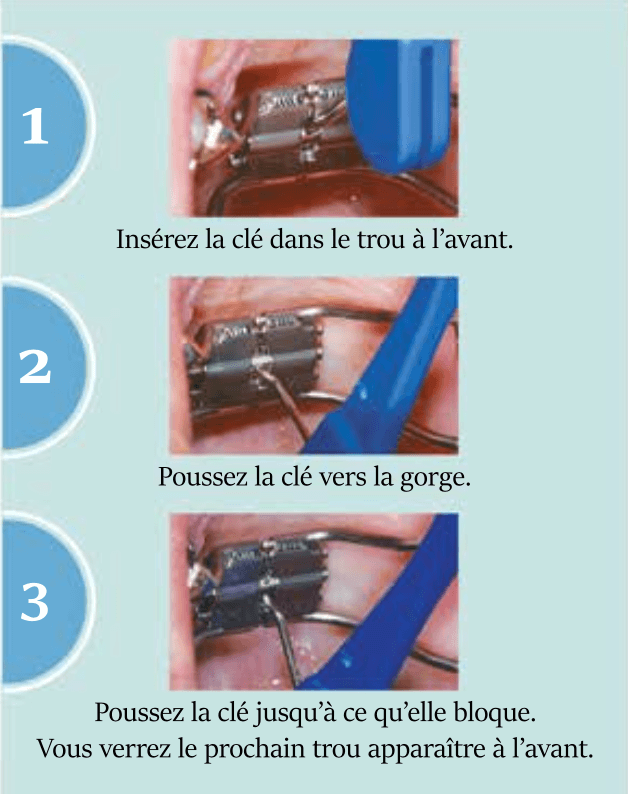 L'expansion palatine au clinique Orthodontiste G&L